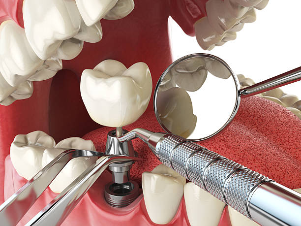 Best Emergency Care for Gum Disease in Mount Pleasant, SC