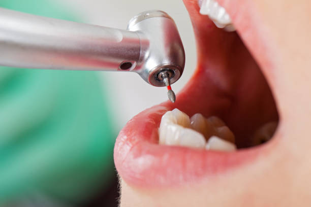 Best Dental Abscess Treatment in Mount Pleasant, SC